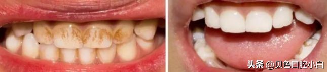宝宝牙齿黄黄的刷不干净怎么办,宝宝不爱刷牙牙齿黑了怎么办