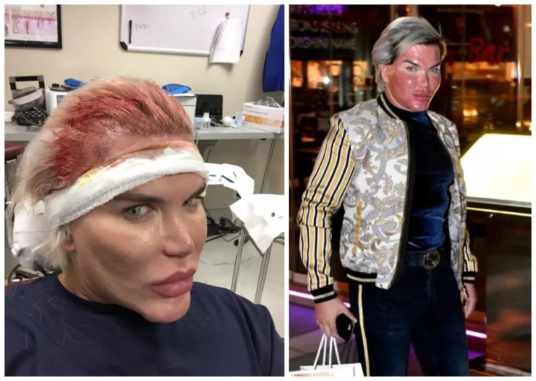 “真人肯尼”痴迷整容多年后，最终将自己整成了女人