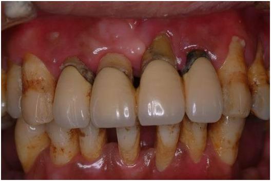 牙周炎引起的口腔溃疡久治不愈,上火引起的牙周炎怎么治疗