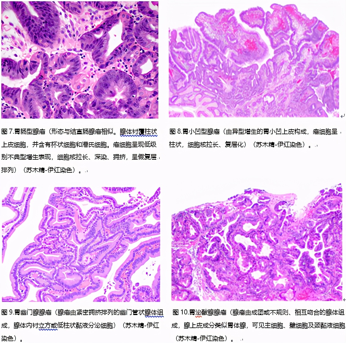 胃息肉可怕不,做胃镜查出胃里有息肉怎么办