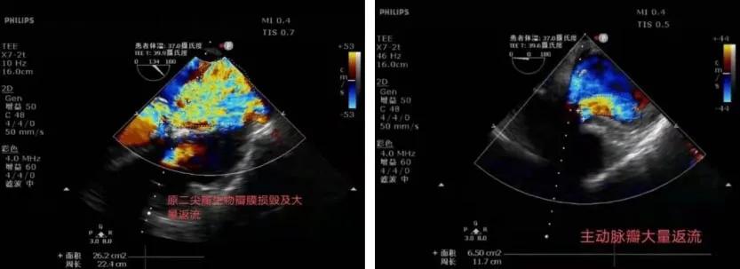 70岁心脏扩大换瓣膜成功率多大,老人心脏瓣膜缺失不做手术行吗