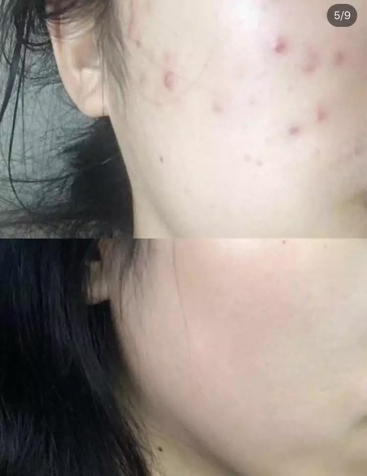 去螨虫慕斯推荐,洗面奶慕斯去螨虫