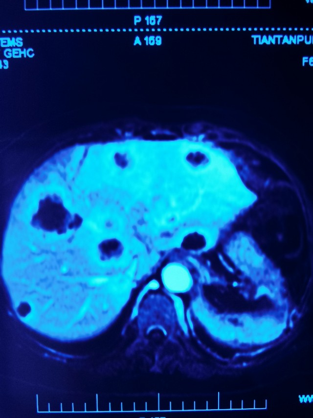 胰腺癌腹膜后多发淋巴转移严重吗,胰腺癌肝内多发转移可以放疗吗