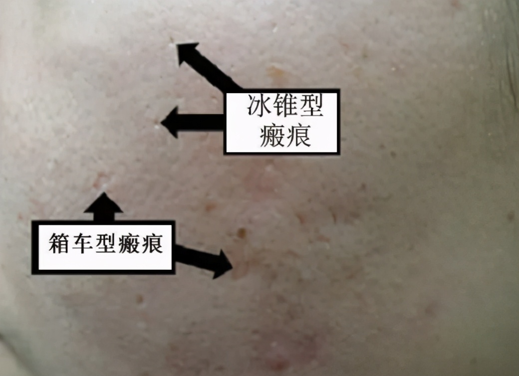 疮疤怎么祛疤,疮疤去除