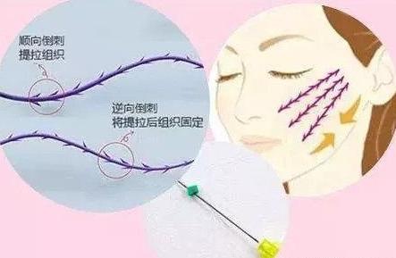 线雕是面部提升最好的方法吗,面部提升最好的方法是线雕吗