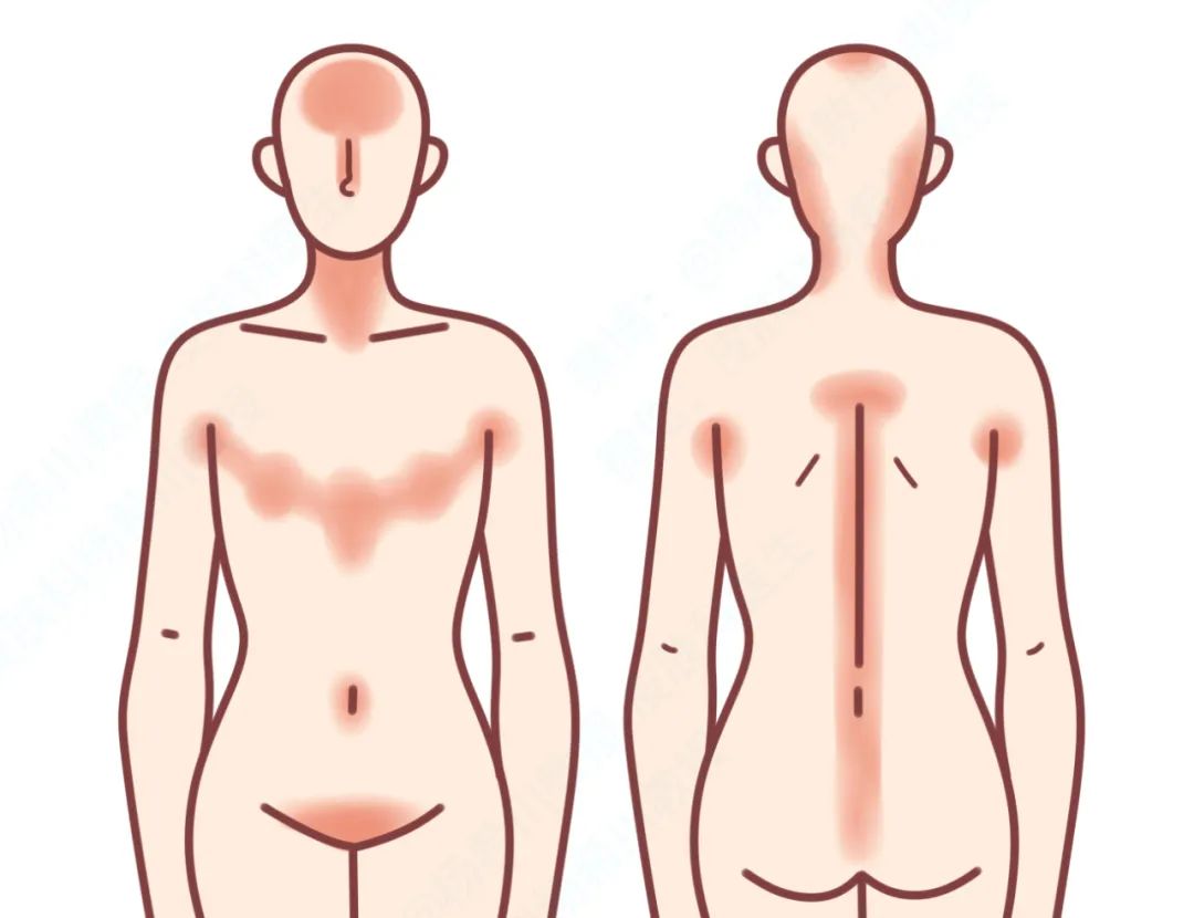 屁股上长痘是什么原因导致,屁股长痘是什么原因造成的