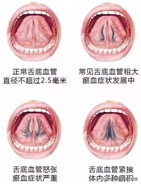 这么多病都是瘀血造成的，化解妙招送给你（深度好文）