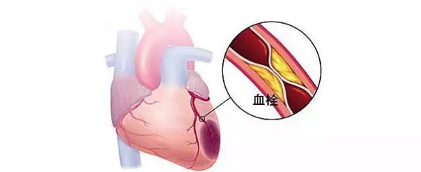 心肌梗死病人能长期喝阿司匹林吗,心肌梗塞后阿司匹林至少吃多久