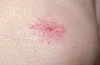 乙肝患者身上出现小红点图片,乙肝肝硬化身上起红点是怎么回事