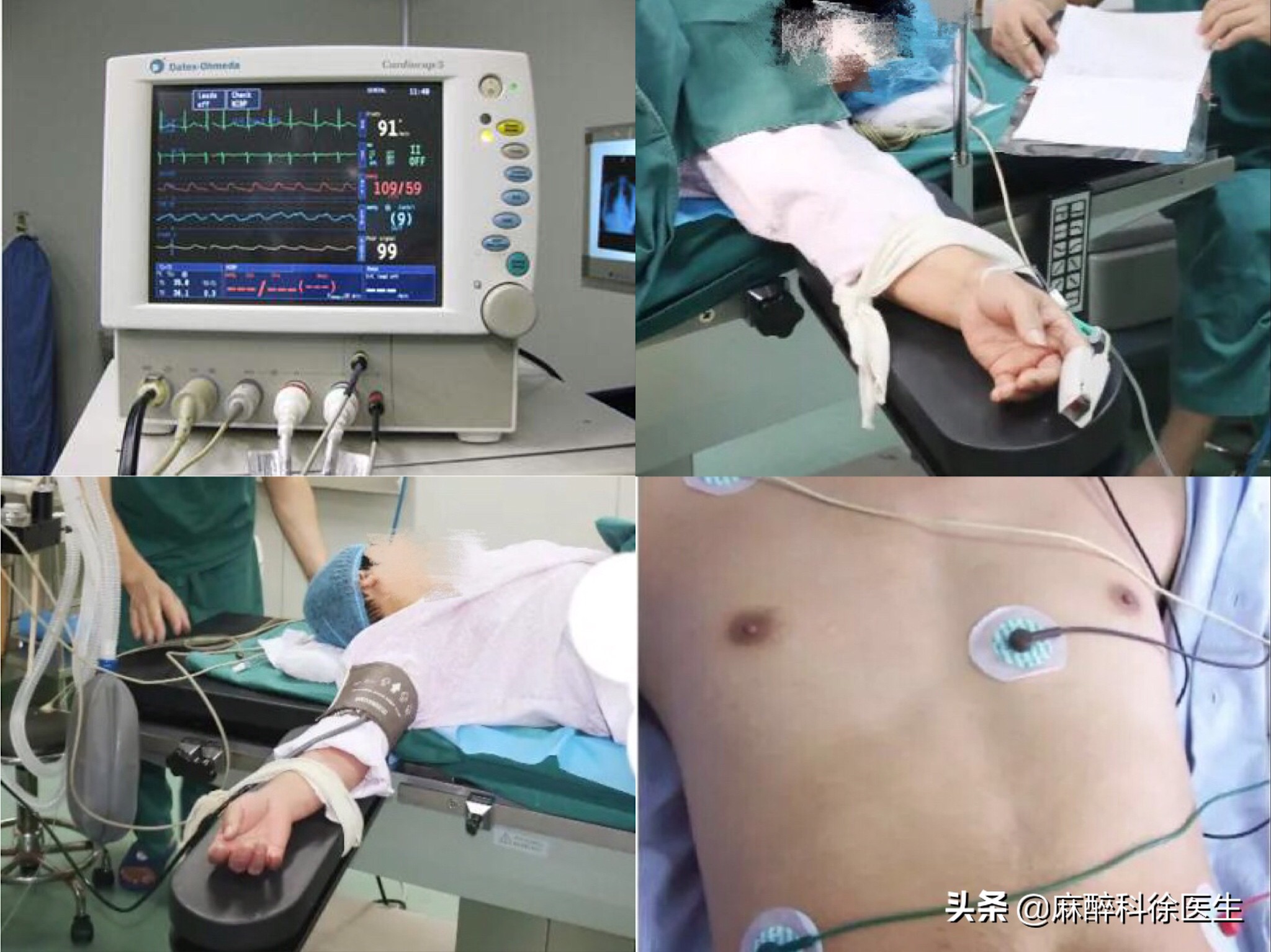 打麻醉是什么体验,半身麻醉多长时间恢复感觉