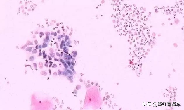 宫颈癌筛查tct和hpv分别代表什么,查宫颈hpv和tct先查哪一项