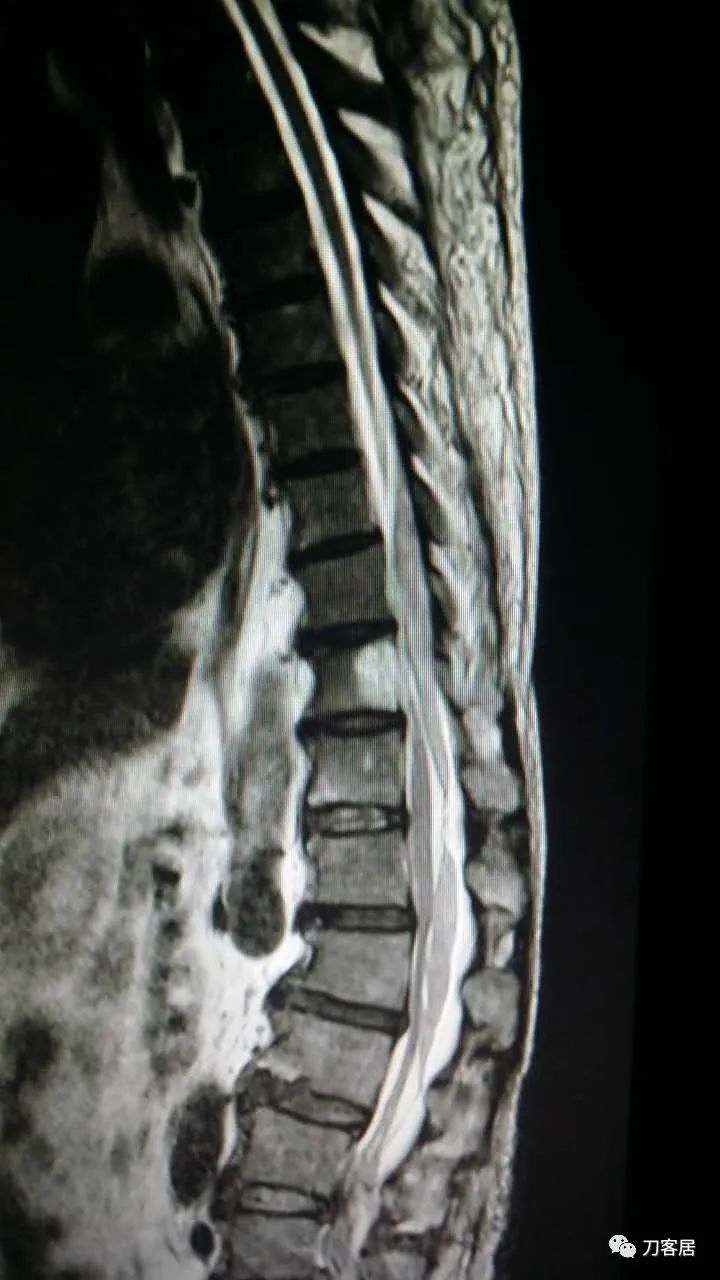 腰椎手术切掉棘突,腰突微创后出血肿