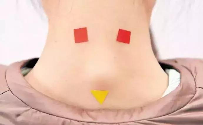 颈椎包夺命包富贵包,颈椎富贵包怎么解决