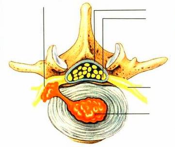 腰椎间盘突出症的临床诊治策略,腰椎间盘突出症的临床诊治