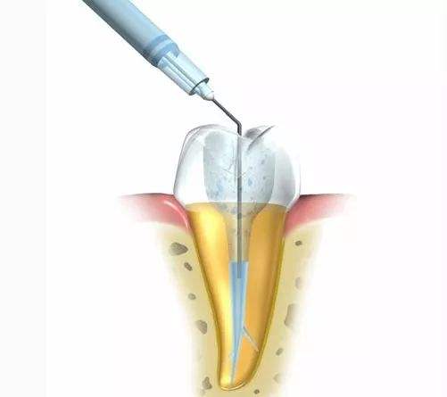 做完根管治疗有必要套牙冠吗,做完根管治疗一定要牙盖吗