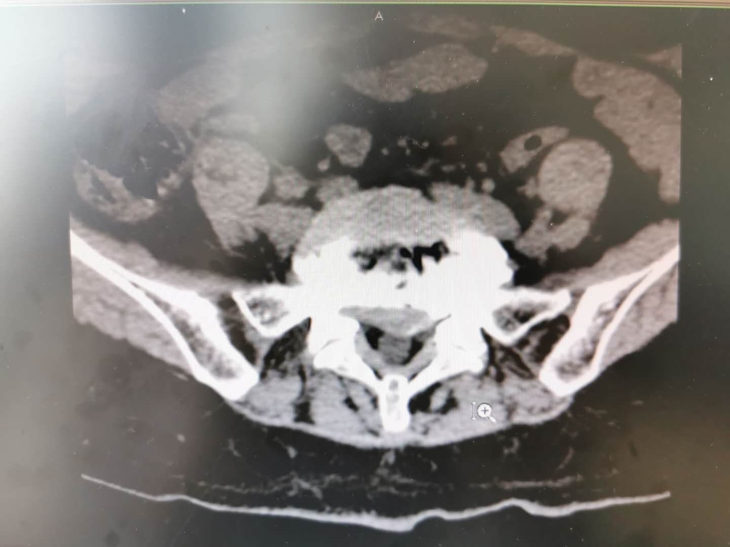 腰痛扎小针刀行吗,腰痛针灸需要吃药嘛