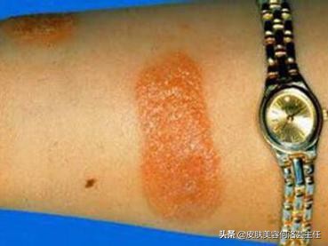 反复出油长痘毛孔堵塞怎么调理,t区出油毛孔大脸颊干是什么肤质