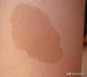 如何阻止咖啡斑增长,怎么避免咖啡斑长脸上