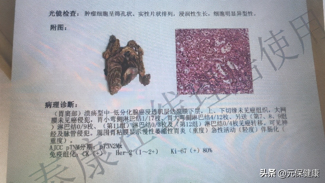 我亲历的保险理赔|治疗胃癌，竟花不到7元钱？