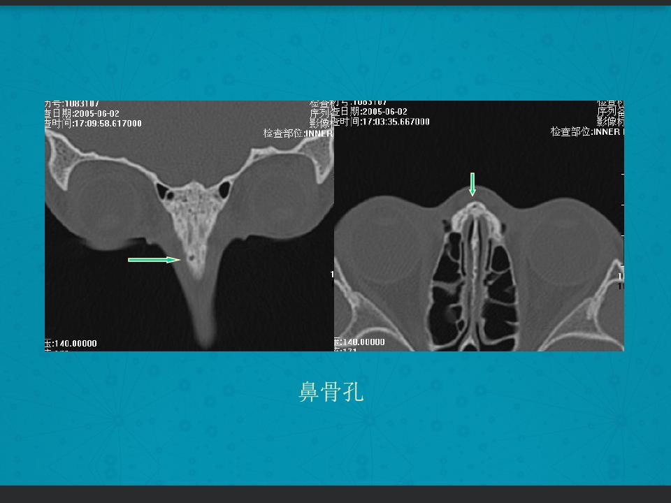 鼻骨骨折复位全过程,诊断证明鼻骨骨折问号是什么意思