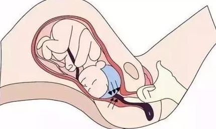 脐带脱垂胎儿存活几率有多大,为什么会发生脐带脱垂