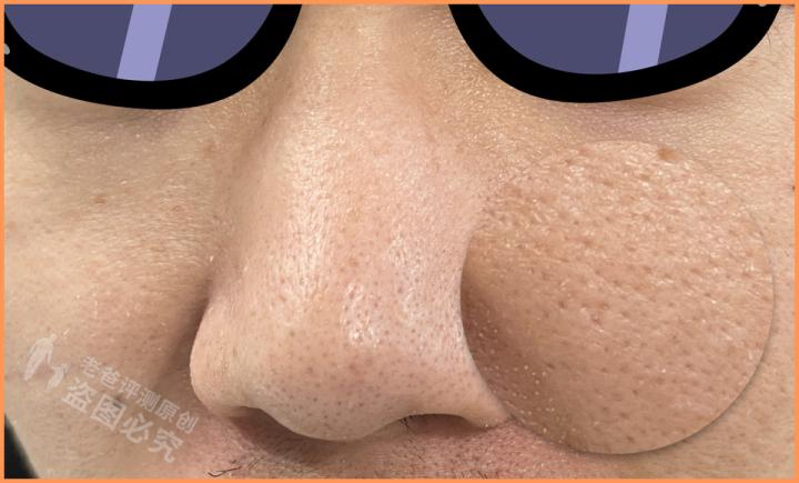 毛孔粗大问题应该如何正确解决,毛孔粗大怎么办教你一招根除