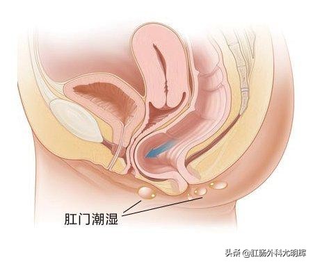 肛门湿疹痒用痔疮凝胶敷料行不,肛门用他克莫司治疗湿疹反而很痒