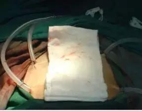 泡热水澡可以治疗肿瘤吗,恶性肿瘤能泡热水澡吗