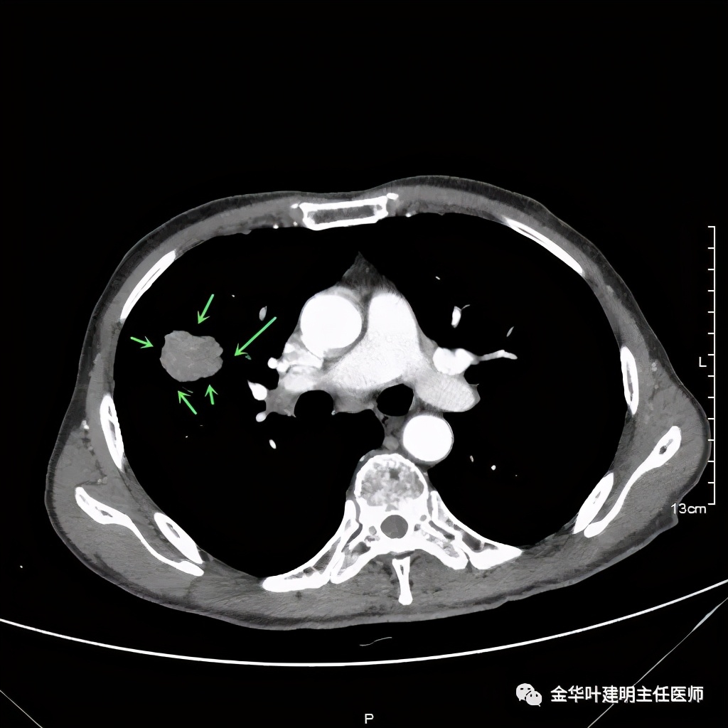 得了肺癌做肺部穿刺有影响吗,肺部穿刺可以确诊肺癌吗