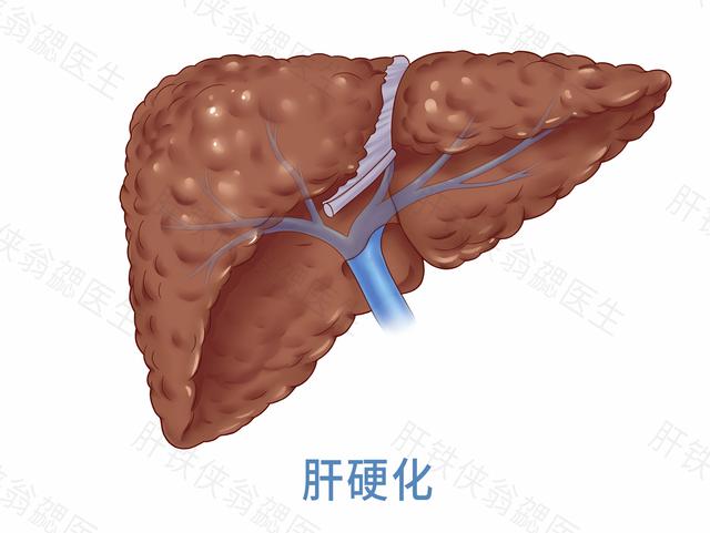 健康知识科普酒精肝要不要治疗,酒精肝需要终身戒酒吗