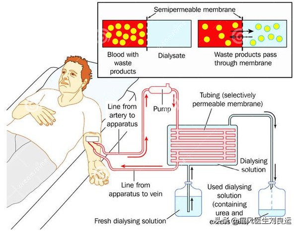 痛风引起的肌酐高怎么治疗,痛风肌酐高需要看肾内科吗