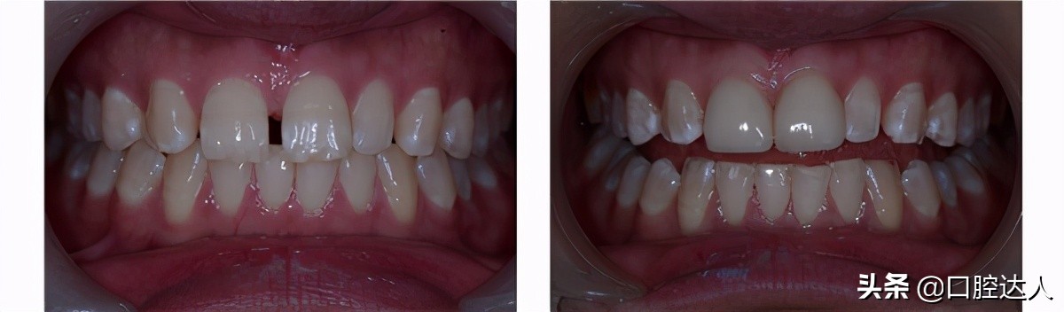 牙套牙缝收缩不了做贴面,有牙缝是做牙套好还是贴面好