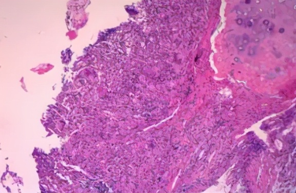 肺炎不干预治疗一般多久可以痊愈,肺炎治疗20天不见好转