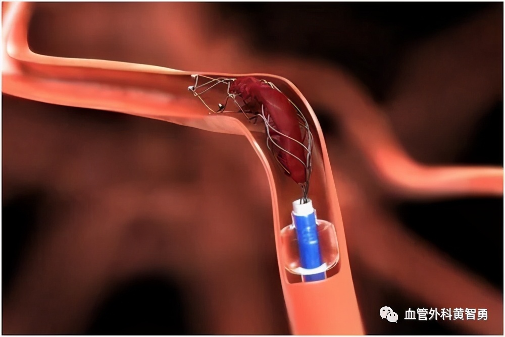 脑血栓取栓最新指南,脑卒中手术介入取栓后多久恢复