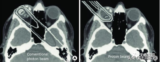 质子治疗手术适合大型肿瘤,肿瘤不能根治吗