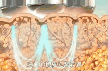 无创医美项目详解:热玛吉到底是啥?有什么副作用么?