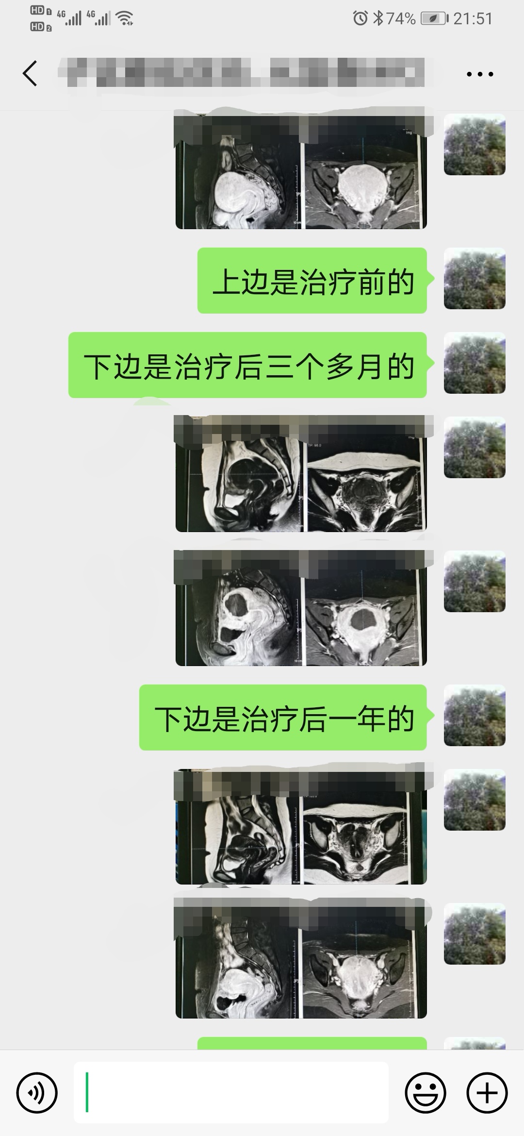 看看痛不欲生的子宫腺肌症痛经专业领域的看法与典型病例