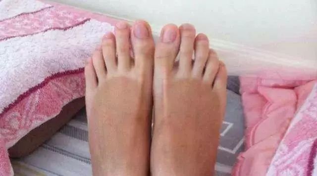 手脚干裂皮肤又厚又痒怎么办,冬天手脚干裂起皮怎么治疗