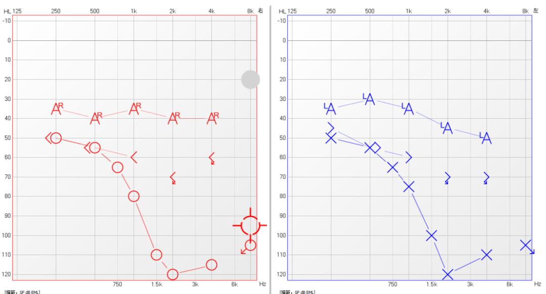 重度耳聋戴小型助听器能听到吗,极重度听力损失带助听器