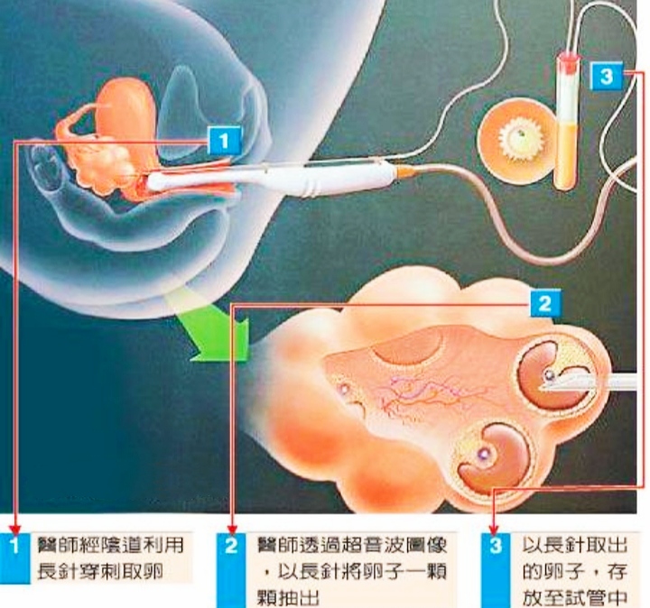 取卵冻卵，代孕弃养，郑爽事件背后：我们拿什么保护我们的女儿？
