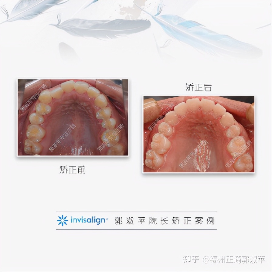 牙齿龅牙矫正过程全记录33岁,大龅牙牙齿矫正成功案例和费用