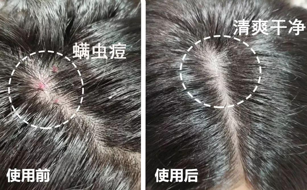 去头屑去螨虫哪个洗发水最有效,去头屑去螨虫用哪个洗发水最有效