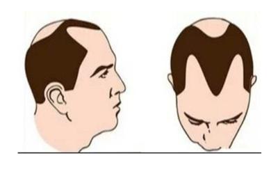 25岁男生脱发是因为肾虚嘛,男的脱发严重脸色也不好是肾虚吗