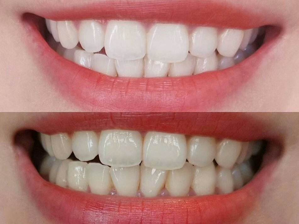 王子文白到发光的秘密,王子文牙齿美白