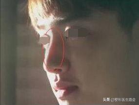 硅胶隆鼻会破坏原来的鼻子吗,隆鼻硅胶可以永久不取吗