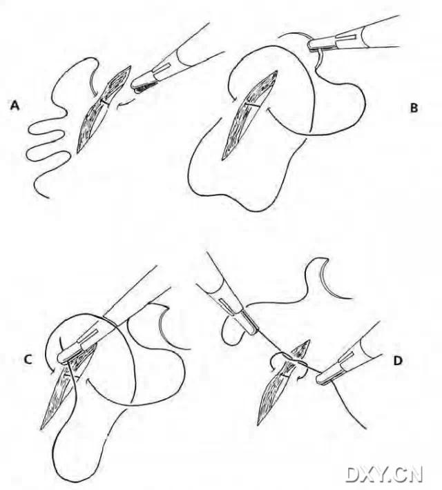 实用大全：腹腔镜下缝合与打结