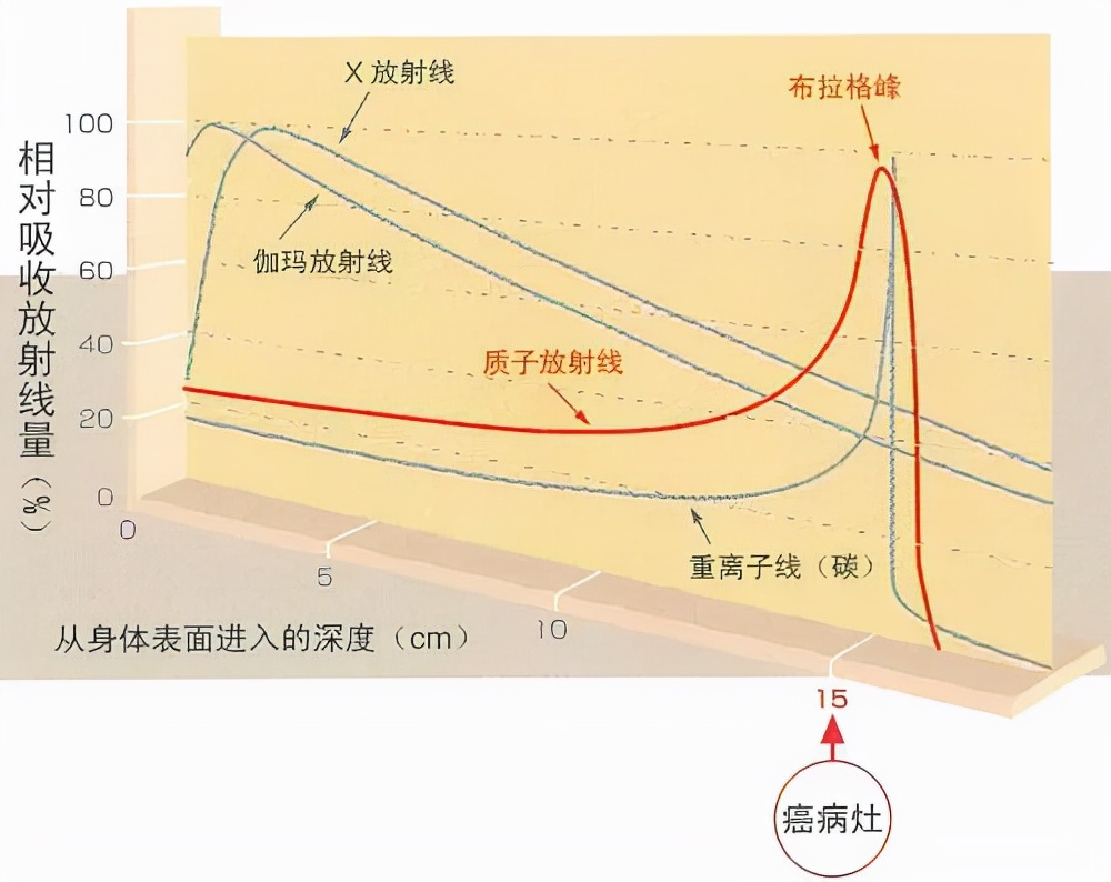 质子重离子治疗真实效果图,重离子治疗全过程
