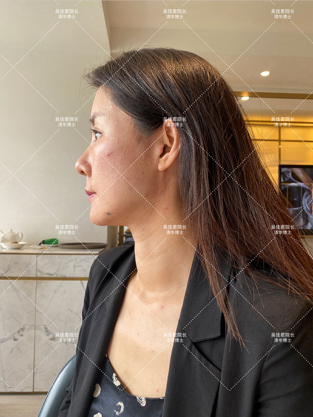 拉皮手术后三个月的恢复过程,拉皮术后10天白天可以不戴头套吗