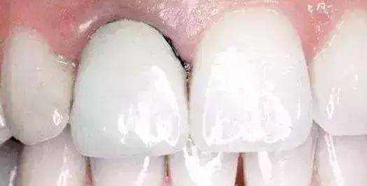 为什么烤瓷牙表面有裂纹,为什么烤瓷牙的牙龈那么黑