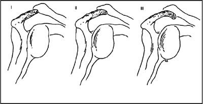 肩肌劳损怎么练肩,肩膀疼痛还能继续练肩嘛